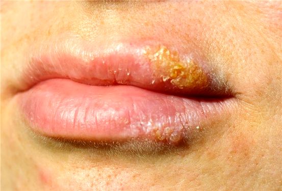 Psoriasis vs Herpes: Was ist der Unterschied?