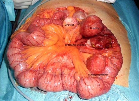 Seltene Symptome von Multiple Sklerose: Was ist Trigeminusneuralgie?