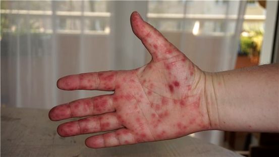 Hand-, Fuß- und Munderkrankungen: Risiken, Behandlung und Prävention