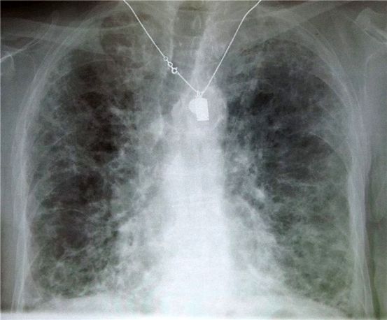 Pulmonary Fibrosis: Kahulugan at Pag-aaral ng Pasyente