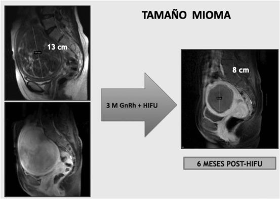 Cómo se usa el ultrasonido para tratar la artritis reumatoide