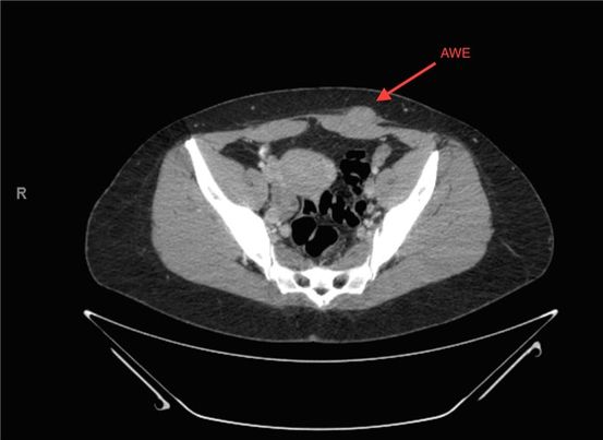 Leuprolide (Lupron) para el cáncer de próstata