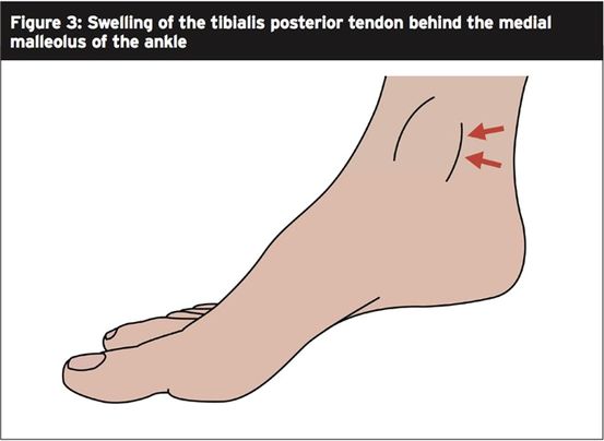 Disfunción del tendón tibial posterior (Disfunción del nervio tibial)