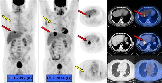 Etapa 4 Cáncer de mama: recurrencia y remisión