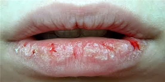 Labios quemados por el sol: Inflamación, tiempo de curación y más