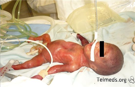 Síndrome de distrés respiratorio neonatal