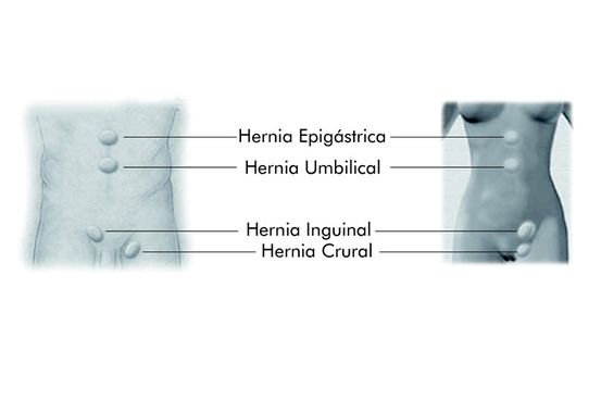 Terrones abdominales: Causas, síntomas y Pruebas