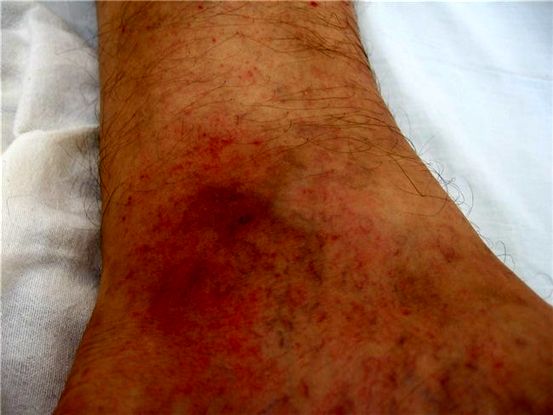10 Signos iniciales de lupus