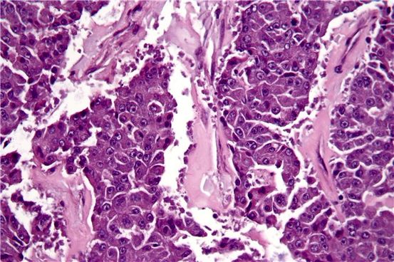 Metastásico Cáncer de seno en el páncreas: conozca los hechos