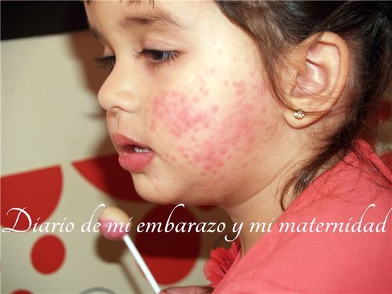 Enfermedad de manos, pies y boca: riesgos, tratamiento y prevención