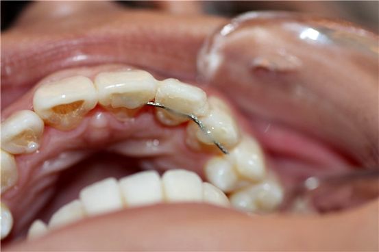 Caries del diente: Síntomas, Causas , y Tratamientos