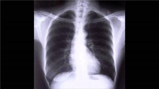 Insuficiencia respiratoria aguda: causas, síntomas y diagnóstico