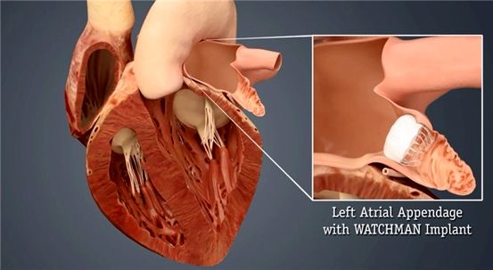 Implantable Cardioverter Defibrillaattori (ICD)