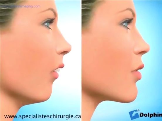 5 Façons de préparer votre maison à la chirurgie du remplacement du genou