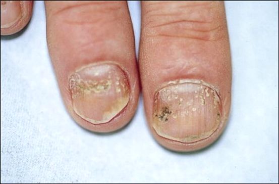 Pellicules ou psoriasis: Apprenez les signes