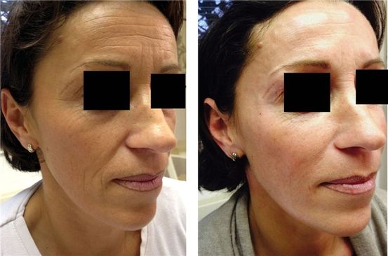 Botox pour hyperactivité vésicale