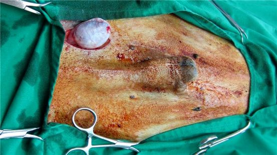 Cancer de l'ovaire en images