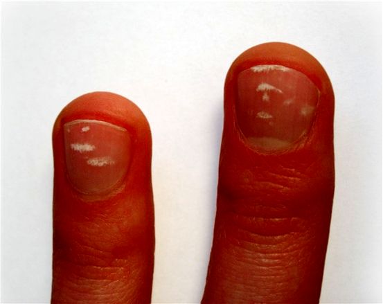 Psoriasis des ongles: images, symptômes et traitements