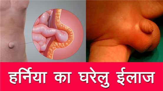 हर्निया: कारण, उपचार, और रोकथाम