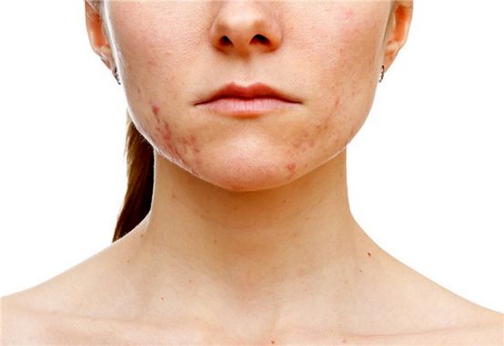 Gravidanza Acne: 6 Trattamenti completamente naturali