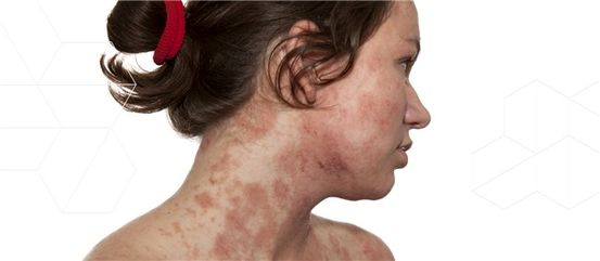 Incontinenza- Dermatite associata: sintomi, trattamento e altro