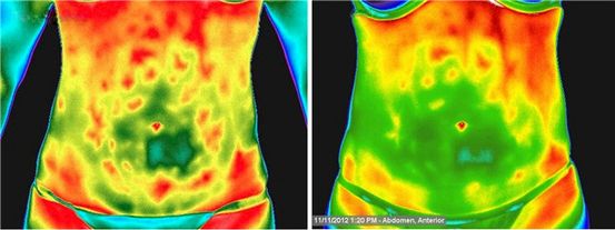 ProstaScint Scan en diagnose van geavanceerde prostaatkanker