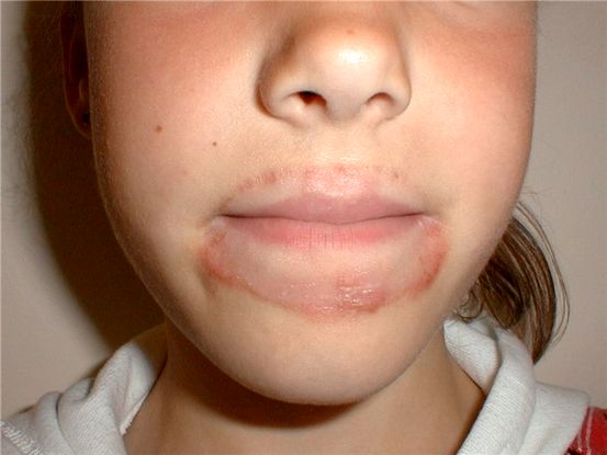 Straling Dermatitis: oorzaken, symptomen en 5 behandelingsmethoden