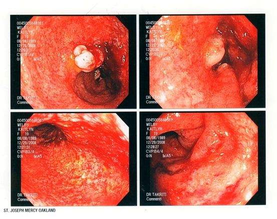 Colitis ulcerosa: een maaltijdplan maken