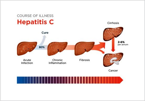 Hepatitis C-medicatie: kosten, bijwerkingen en meer