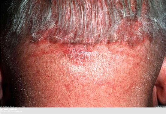 Psoriasis og Thrush: Er det en forbindelse?