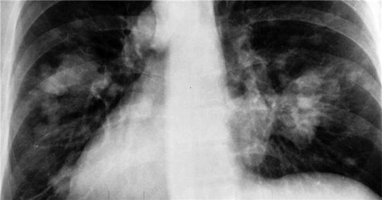 Carcinom pulmonar cu celule mici: Speranța de viață și prognostic