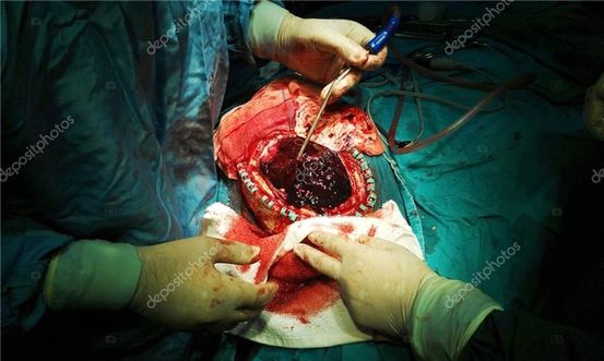 Hematom subdural: Simptome, diagnostic și tratamente