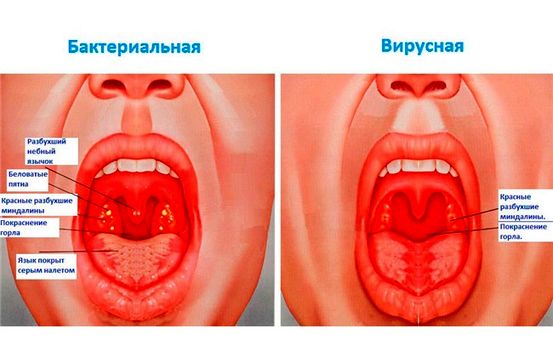 Полицитемия Вера Осложнения и риски