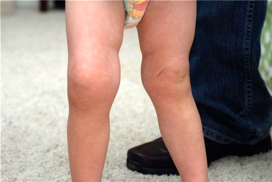 Коленный шум: Crepitus и Popping Explained