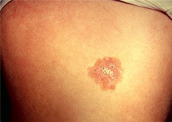 Psoriasis vs Seborrheic dermatit: vilken är den?