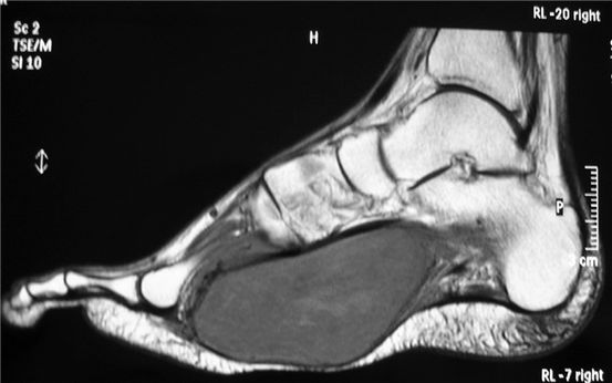 Ayak Melanomu: Belirtiler, Sebepler ve Tedaviler