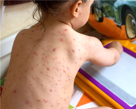 Các biến chứng của bệnh tim: Ảnh hưởng lâu dài và ngắn hạn