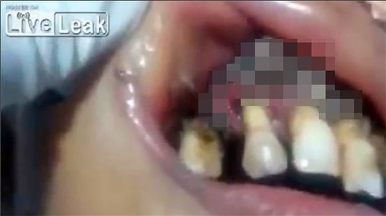 Khó nuốt và GERD: Giảm nhẹ khó nuốt