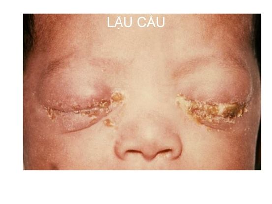 Viêm màng não cầu khuẩn: Các triệu chứng. Nguyên nhân và hơn